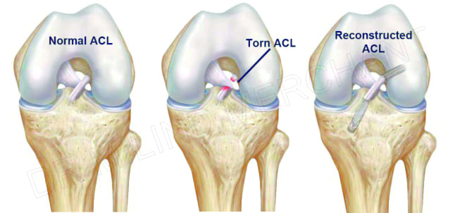 Posterior cruciate ligament (or PCL) Injury