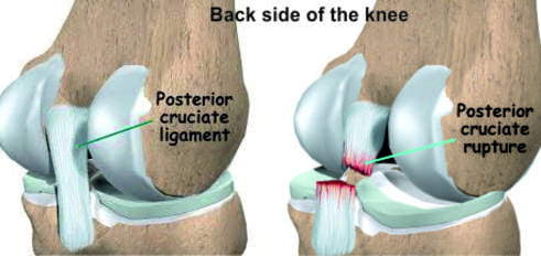 Posterior cruciate ligament (or PCL) Injury