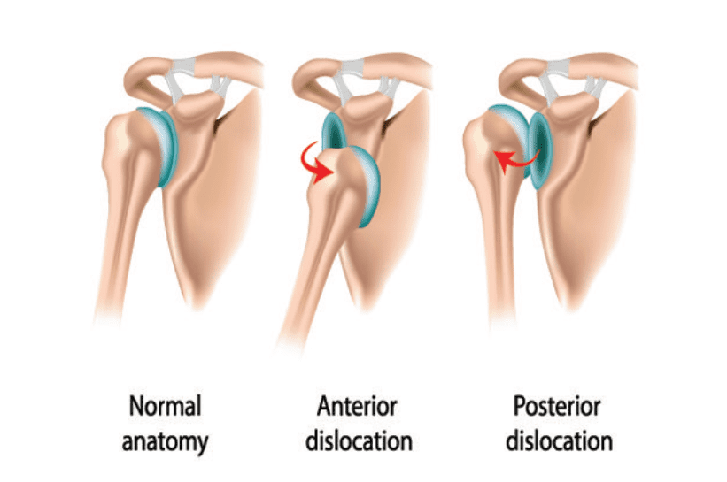 Recurrent Shoulder Dislocations