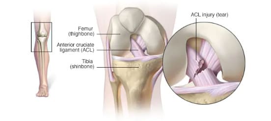 knee ACL injury 