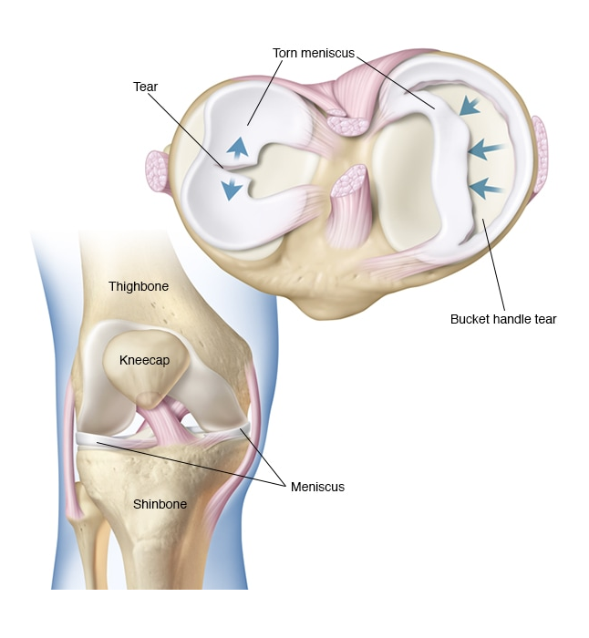 So what are different types of Meniscus tears