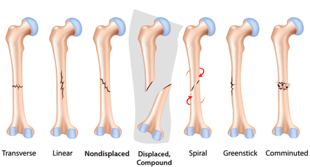 types of fracture