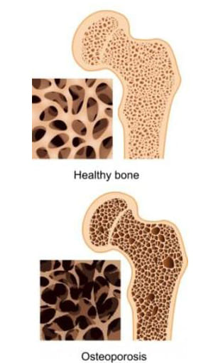 How do I know I have Osteoporosis
