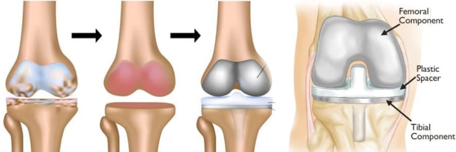 Total knee replacement (TKR)