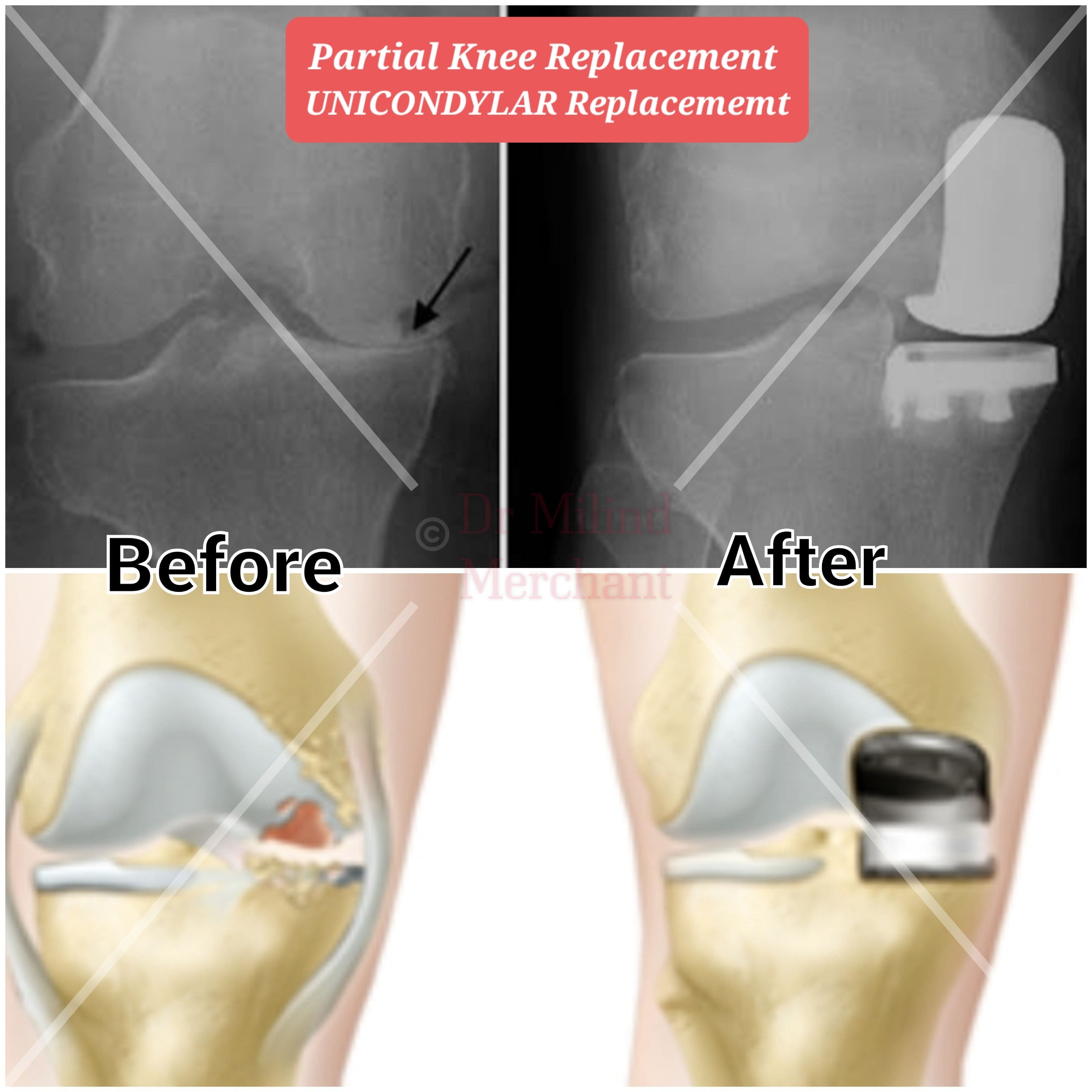Partial knee replacement